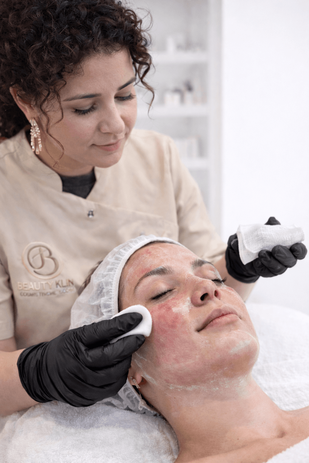 TCA chemische peeling behandeling bij Beauty Icon Almere