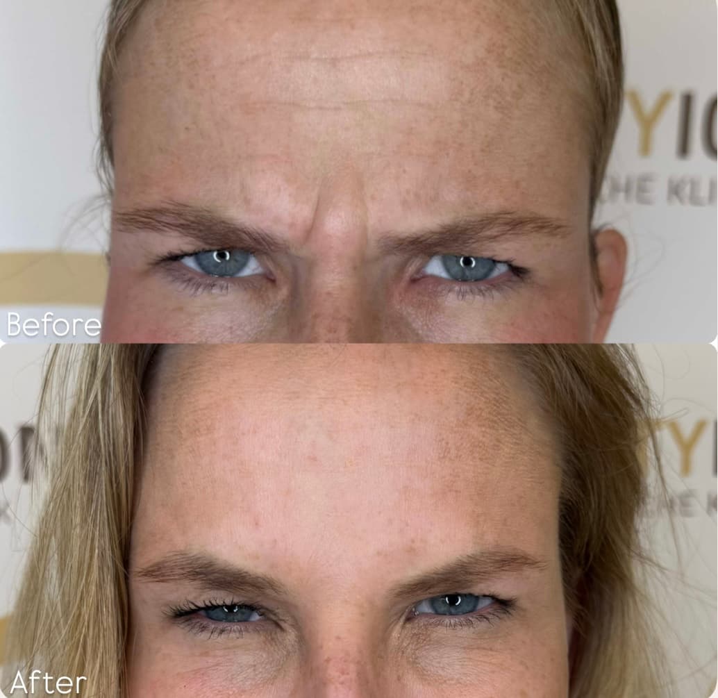 Frons rimpel procedure