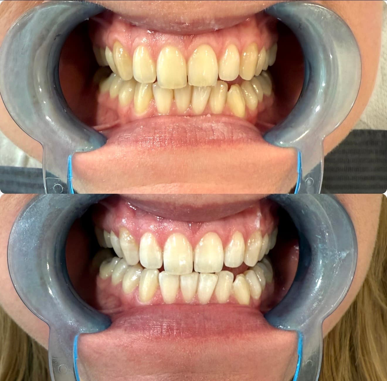 Tanden bleken procedure