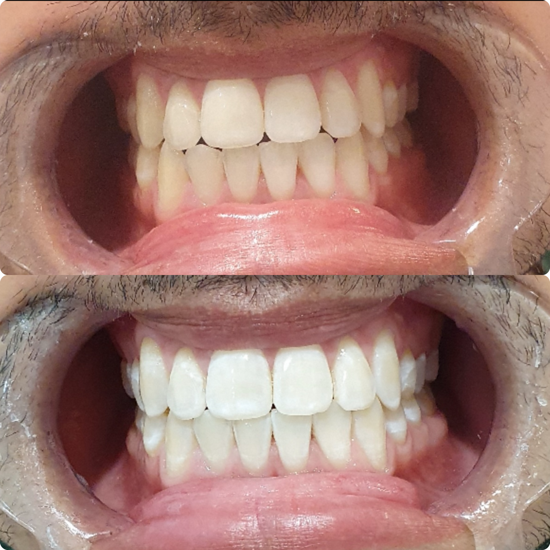 Tanden bleken